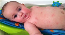 بررسی علل کهیر پوستی در کودکان و درمان آن