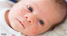 علت بروز جوش و آکنه در بعضی نوزادان چیست؟ ‏
