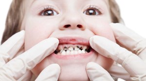 راه های پیشگیری از پوسیدگی دندان در کودکان