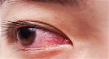 آلرژی چشم چیست و چگونه درمان میشود؟