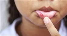 بررسی علل آفت دهان و نحوه درمان آن