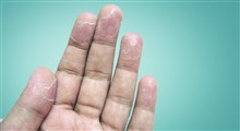 از علت تا درمان پوسته پوسته شدن انگشتان دست