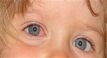 چگونه می توان از سرایت عارضه چشم صورتی به دیگر اعضاء خانواده و سایر فرزندان جلوگیری کرد؟