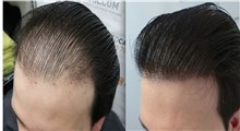 کاشت مو چیست و چه عوارضی دارد؟