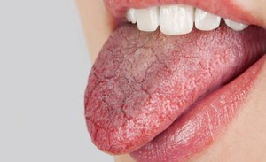 دلایل خشکی دهان چیست؟