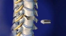 درمان دیسک گردن با اصلاح فعالیتها، فیزیوتراپی، درمان دستی، دارو و ..