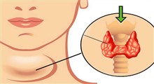 آنچه باید درباره کم کاری تیروئید بدانید