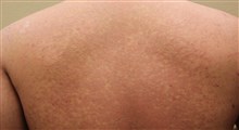 بیماری پوستی تینه‌آ ورسیکالر چیست؟