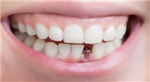ایمپلنت دندان و هر آنچه باید درباره آن بدانید