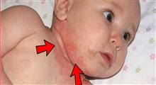 علت وجود بثورات پوستی بر روی گردن کودک 4 ماهه ام چه می باشد؟