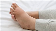 چگونه از ورم پا در مسافرت با ماشین، قطار و ... پیشگیری کنیم؟