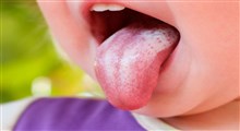 علت برفک دهانی چیست؟و راه درمان آن چه می باشد؟