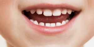 چگونه از دندان شیری کودکان مراقبت کنیم؟
