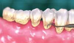 آنچه از جرم گیری دندان باید بدانید (بخش اول)