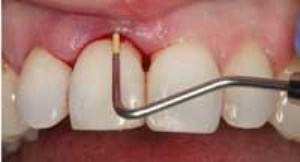 آنچه از جرم گیری دندان باید بدانید (بخش دوم)