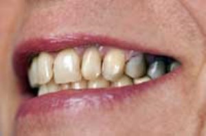 آنچه که از پوسیدگی دندان باید بدانید