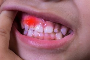 اختلالات دهانی در کودکان