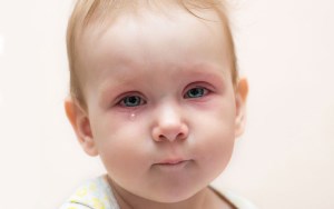 التهاب پلک یا بلفاریت در کودکان و درمان آن