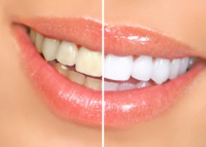 راهکارهای خانگی برای سفید کردن دندان