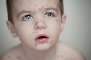 سرخک در کودکان، علائم، عوارض و جلوگیری از آن