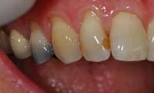 پوسیدگی دندان ، دلائل-علائم و پیشگیری آن (بخش اول)