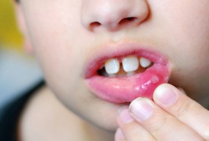 آفت دهان در کودکان، دلایل و درمان آن