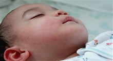 مشکلات پوستی نوزادان و روش درمان آن (بخش اول)