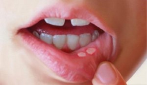 آفت دهان: دلایل، درمان و پیشگیری
