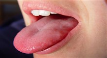 سرطان زبان، علائم، تشخیص و درمان آن (بخش دوم)