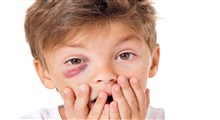 نکاتی درباره صدمات چشمی در کودکان