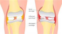 علائم، تشخیص و درمان آرتروز زانو (بخش دوم)