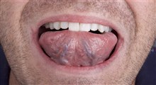 سرطان زبان، علائم، تشخیص و درمان آن (بخش سوم)