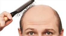 درمان ریزش موی ارثی!