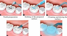 دندان خراب چگونه پر میشود؟