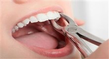 چه کارهایی دندان ما را خراب می‌کند؟!