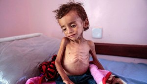 وضعیت اسف‌بار کودکان در یمن