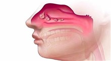 درمان خشکی مجرای بینی و گوش/ دکتر مژده پورحسینی