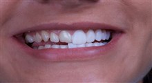 بررسی مهمترین مزایا و معایب لمینت دندان