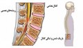 تنگی کانال نخاعی و درمان آن