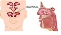 پولیپ بینی و درمان های خانگی