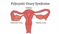 علائم و علل سندرم تخمدان پلی‌کیستیک (PCOS) و تشخیص و درمان آن