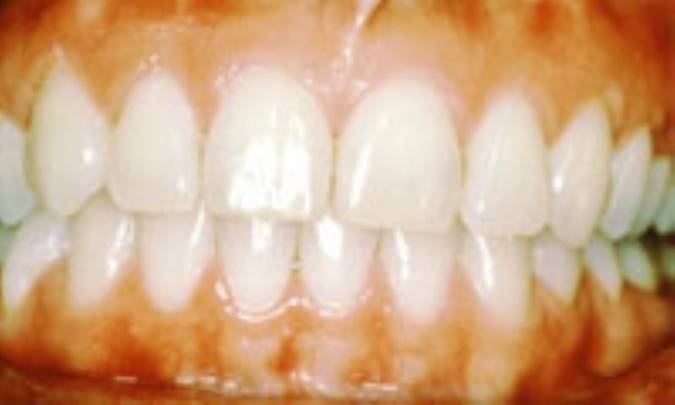 تحلیل لثه از تشخیص تا درمان