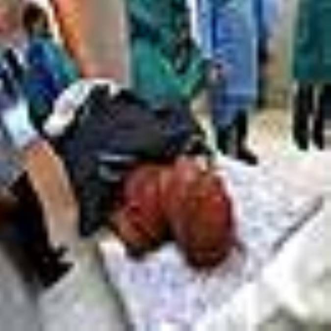 کمک های اولیه انواع ســوختگى