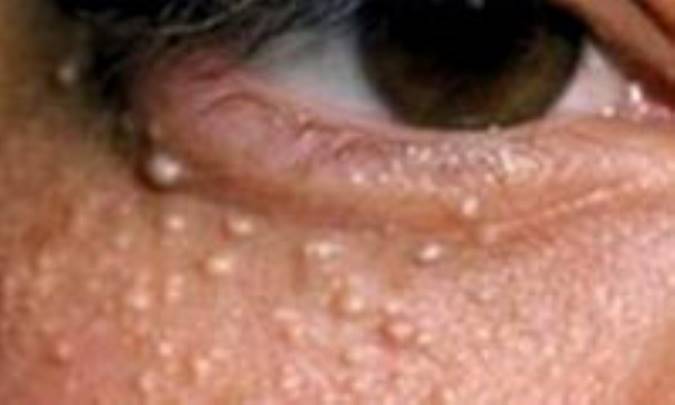 دانه‌های سفید زیرچشم