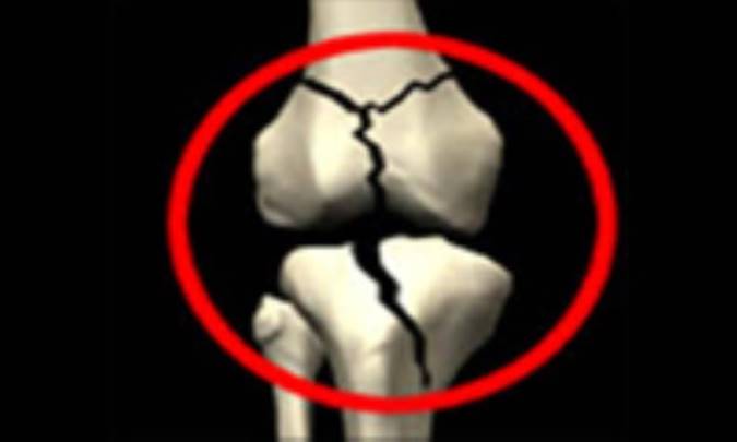 ورزش های پوکی استخوان