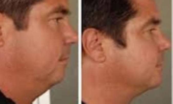 سه تمرین موثر برای رفع غبغب