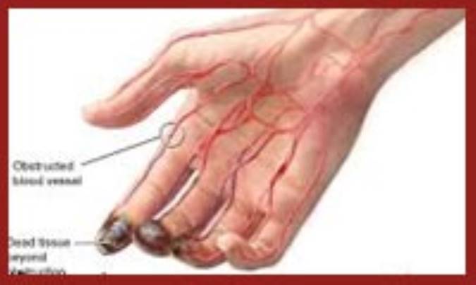 درمان بیماری‌ دست، پا و دهان