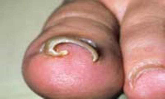 فرو رفتن ناخن در گوشت