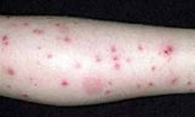 نيش و گزش حيوانات