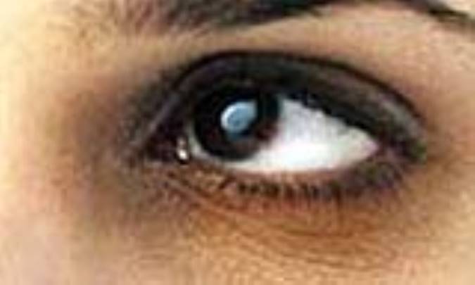 کبودي دور چشم